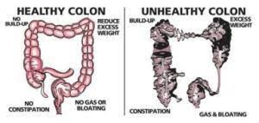 Preventing Colon-Related Health Issues: Did You Know That Death Begins in the Colon?